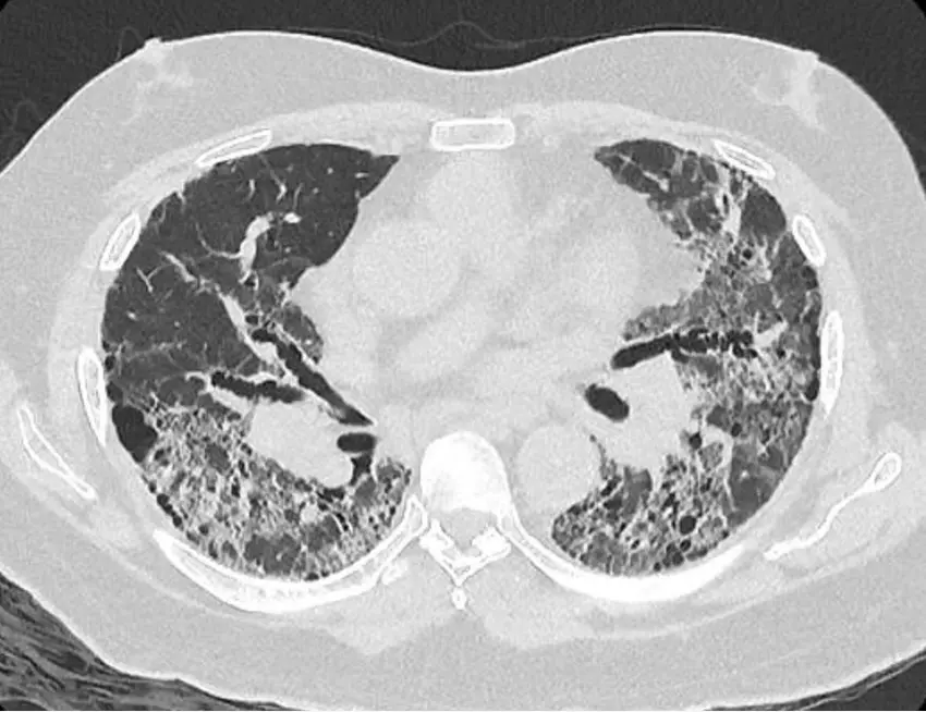 Tratamento de Fibrose Pulmonar em Salvador